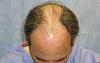 Top of Head and Hair Line before 
 
View his full photoset >> http://www.bernsteinmedical.com/hair-transplant-photos/portraits/patient-fzi/