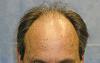 Detail of Hair Line Before Procedure 
 
View his full photoset >> http://www.bernsteinmedical.com/hair-transplant-photos/portraits/patient-fzi/