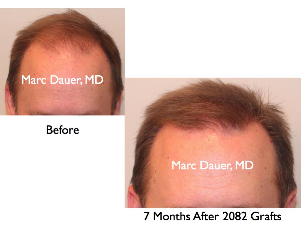 Click image for larger version

Name:	Hair Transplant Slides.263.jpg

Size:	57.3 KB
ID:	35170