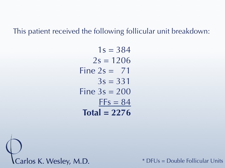 This 28-year-old desired the most natural appearing surgical hair restoration. He elected to have a session with Dr. Carlos K. Wesley in New York...