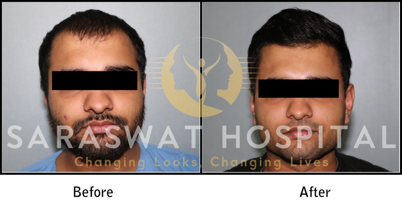 Hair Transplant Surgery Results in India