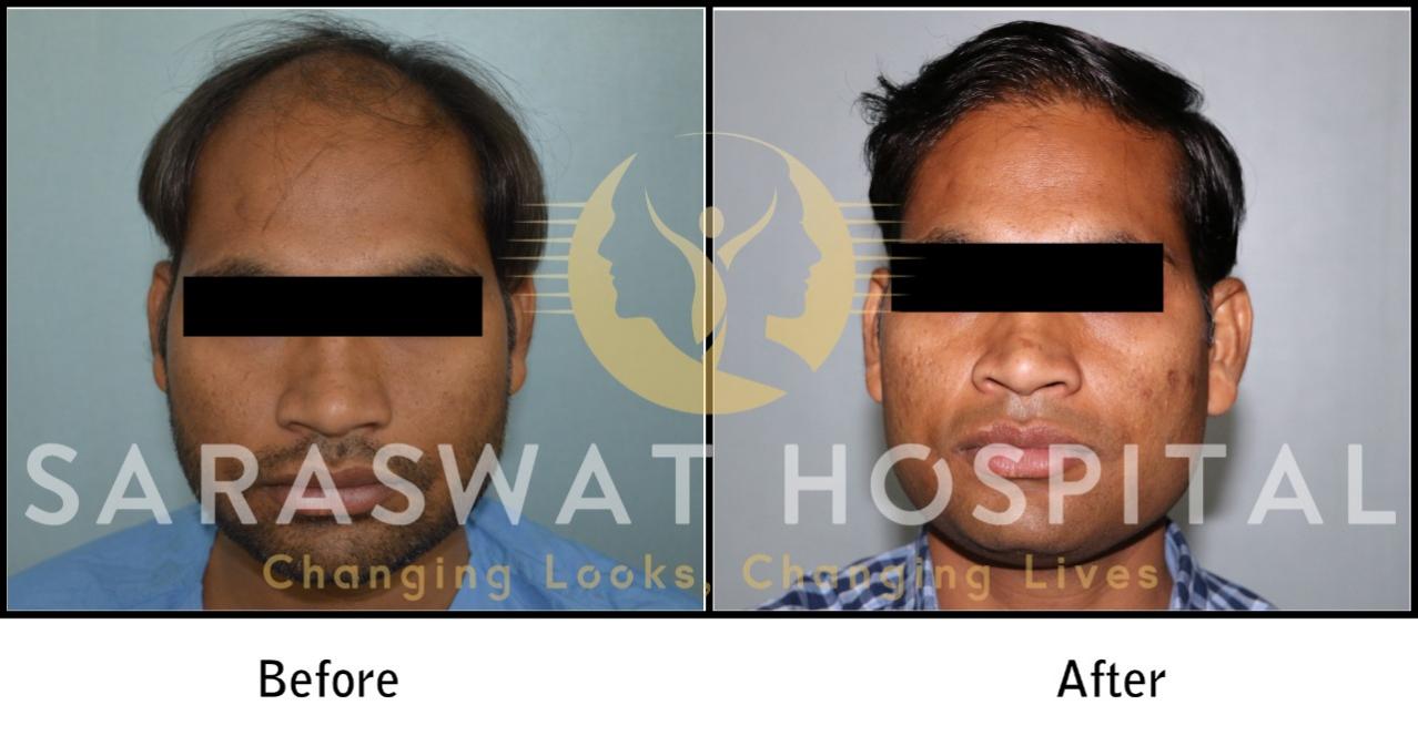 Hair Transplant Surgery Results in Agra