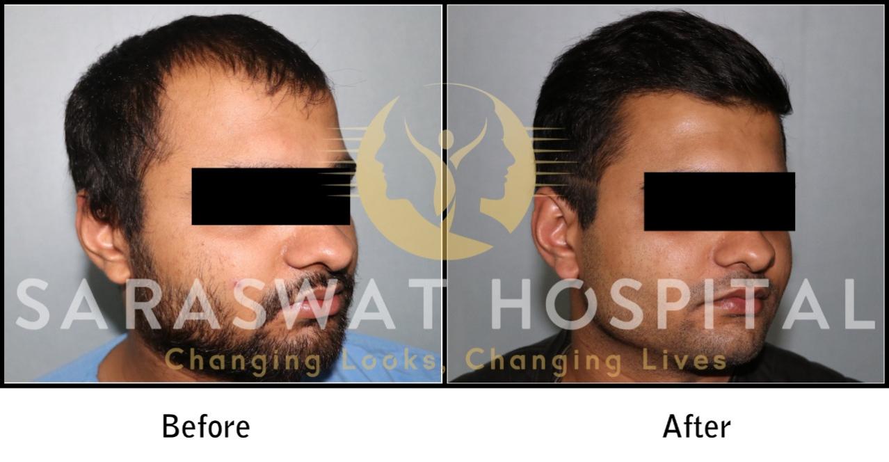 Hair Transplant Before After Results in Agra