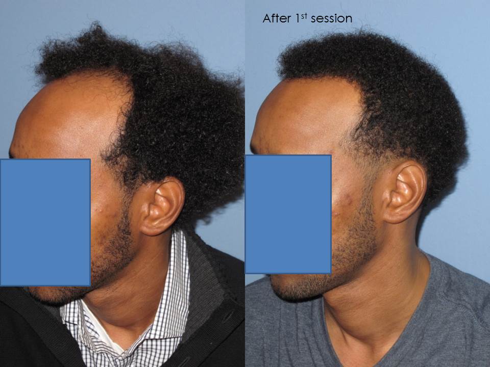 Paul Shapiro, MD 
1st Session FUT = 2339 grafts 
2nd Session FUT = 1706 grafts 
Total for two = 4045 grafts