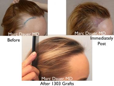 Click image for larger version

Name:	Hair Transplant Slides copy46.001.jpg

Size:	16.4 KB
ID:	46139