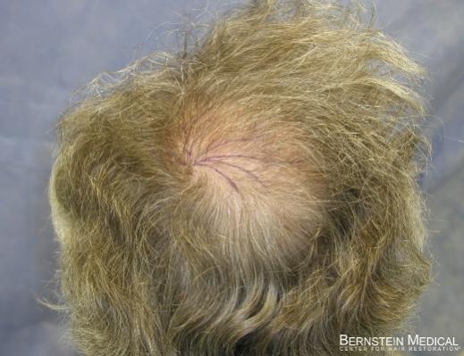 Bernstein Medical's Patient ZLA before hair transplant - Back View 
 
View his full photoset >>...