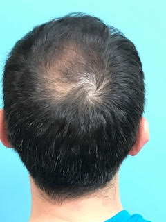 Click image for larger version

Name:	hair-before-back.jpg

Size:	44.9 KB
ID:	58391