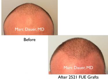 Click image for larger version

Name:	Hair Transplant Slides copy17.001.jpg

Size:	11.0 KB
ID:	44121