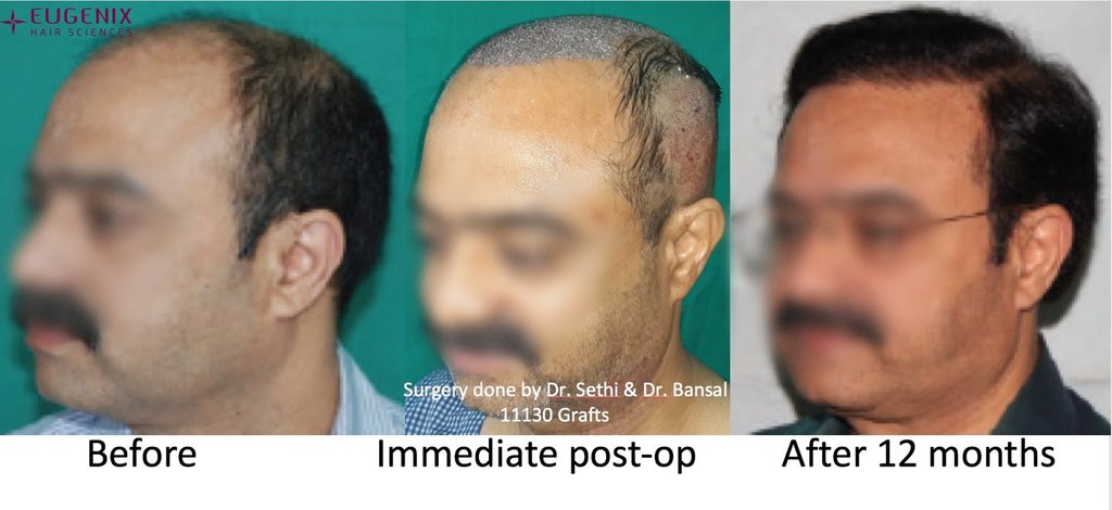 Click image for larger version

Name:	Dr-Pradeep-Sethi-Dr-Arika-Bansal-Eugenix-Result11.jpg

Size:	69.7 KB
ID:	60281