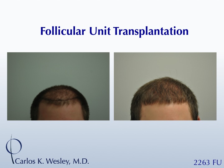 After a 2263 FU strip harvest with Dr. Carlos K. Wesley, this young man continues to wear a short hairstyle with no concern.