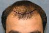 Click image for larger version

Name:	03_planned-hairline.jpg

Size:	55.4 KB
ID:	7305
