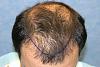 Click image for larger version

Name:	06_planned-hairline-top-view.jpg

Size:	64.5 KB
ID:	7308