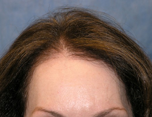 Click image for larger version

Name:	06_after-1st-hair-restoration.jpg

Size:	61.9 KB
ID:	14242