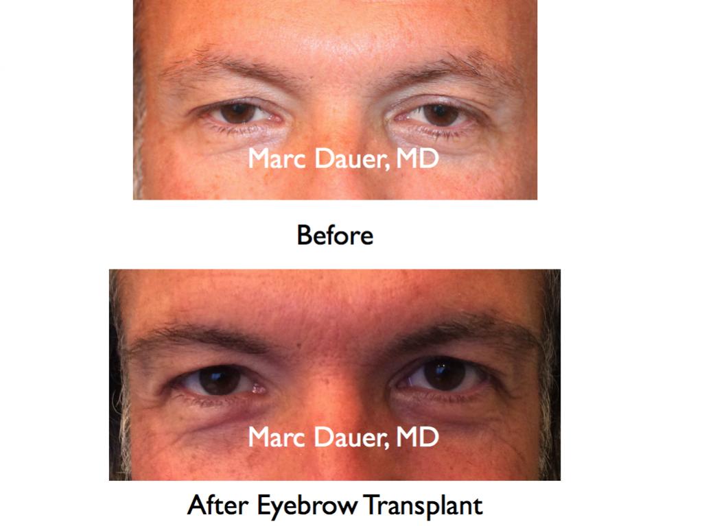 Click image for larger version

Name:	Hair Transplant Slides6.181.jpg

Size:	61.4 KB
ID:	33292