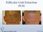 An example of short-term donor area recovery after follicular unit extraction (FUE) with Dr. Carlos K. Wesley (NYC). 
 
A video montage of many more...
