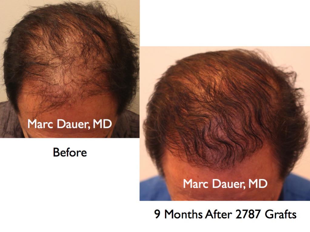 Click image for larger version

Name:	Hair Transplant Slides1.285.jpg

Size:	76.9 KB
ID:	35231