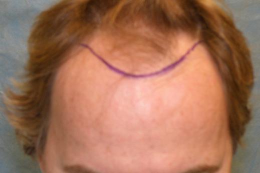 Click image for larger version

Name:	1b-hairline.jpg

Size:	14.2 KB
ID:	35818