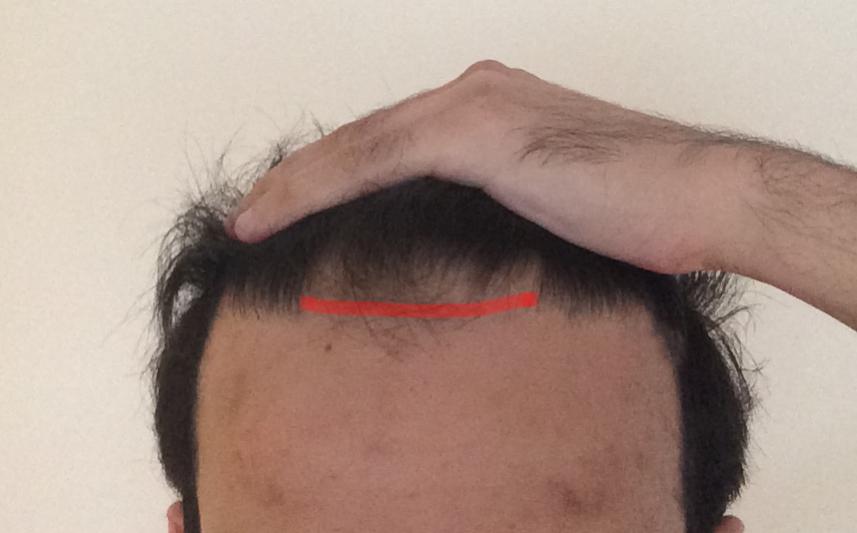 Click image for larger version

Name:	Pre_Op_Hairline.jpg

Size:	36.2 KB
ID:	35853