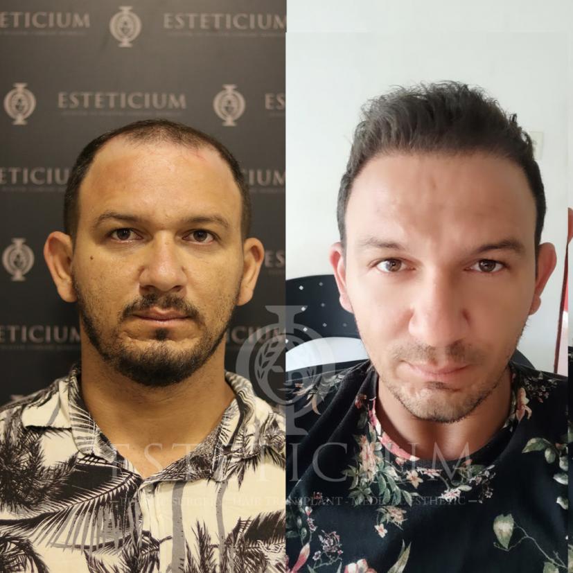 Hair Transplant Before - After