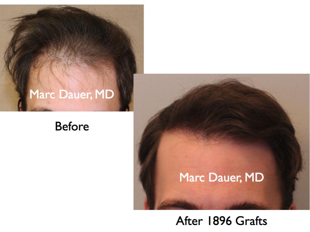 Click image for larger version

Name:	Hair Transplant Slides4.230.jpg

Size:	58.2 KB
ID:	34108
