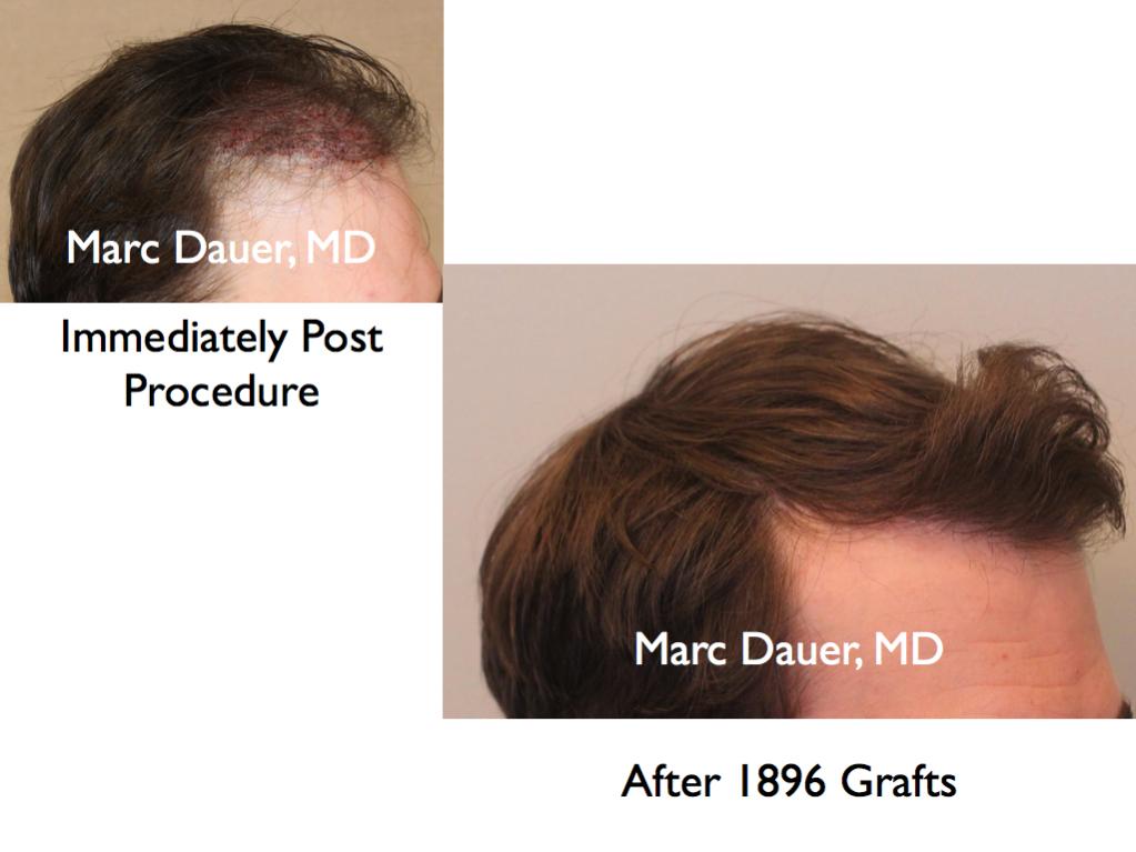 Click image for larger version

Name:	Hair Transplant Slides4.232.jpg

Size:	56.8 KB
ID:	34110