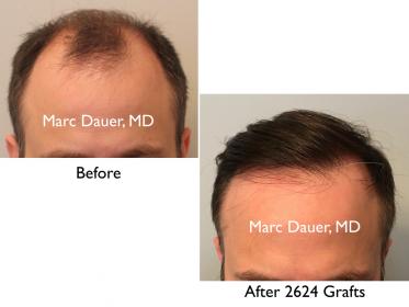Click image for larger version

Name:	Hair Transplant Slides copy9.001.jpg

Size:	11.3 KB
ID:	43494