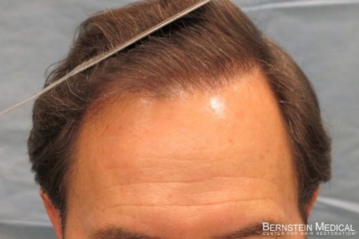 Click image for larger version

Name:	02_after-hair-transplant.jpg

Size:	21.3 KB
ID:	21207