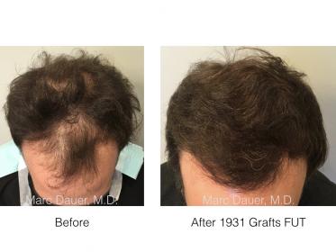 hair transplant photo