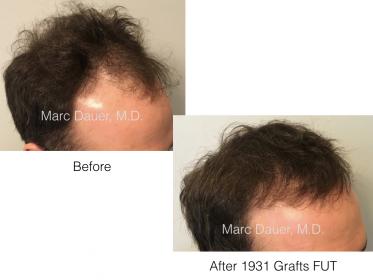 hair transplant photo