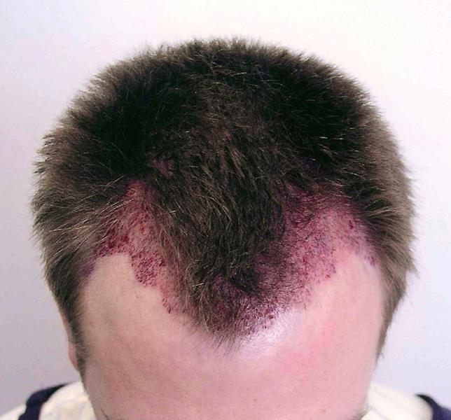 Before hair restoration / Post-op view