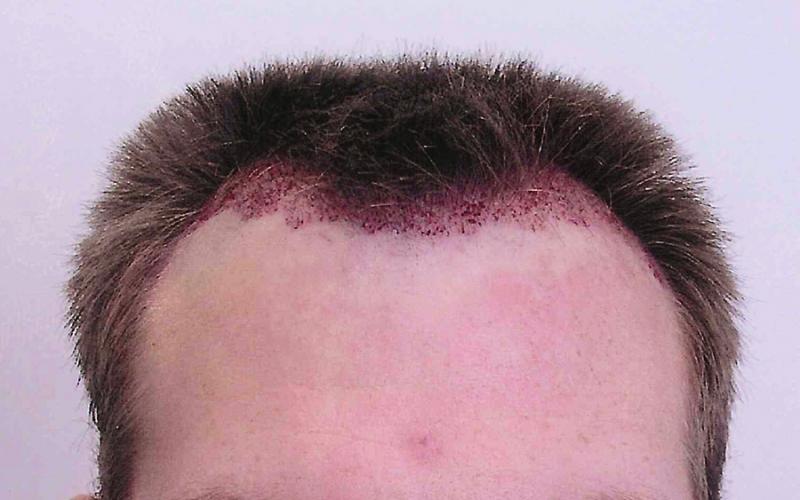 Before hair restoration / Post-op view