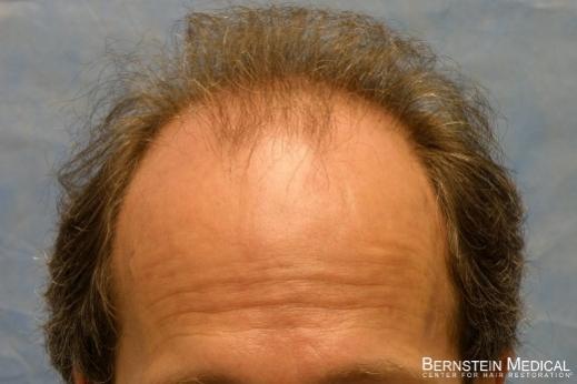 Bernstein Medical's Patient JKJ before hair transplant - Detail of Hairline 
 
View his full photoset >>...