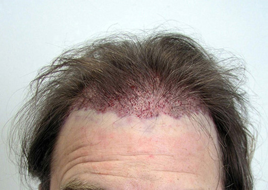 IMMEDIATELY AFTER 1630 FOLLICULAR UNITS PLACED