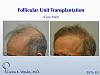 Before/After a treatment with 3976 grafts by Dr. Carlos K. Wesley in New York City. 
 
A video of this patient's transformation may be viewed here:...