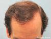 Click image for larger version

Name:	1096_13_3d_after-1st-hair-transplant-top-view.jpg

Size:	24.7 KB
ID:	24050