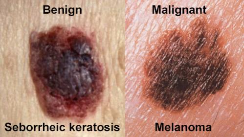 Click image for larger version

Name:	malanoma-SK.jpg

Size:	27.9 KB
ID:	34365