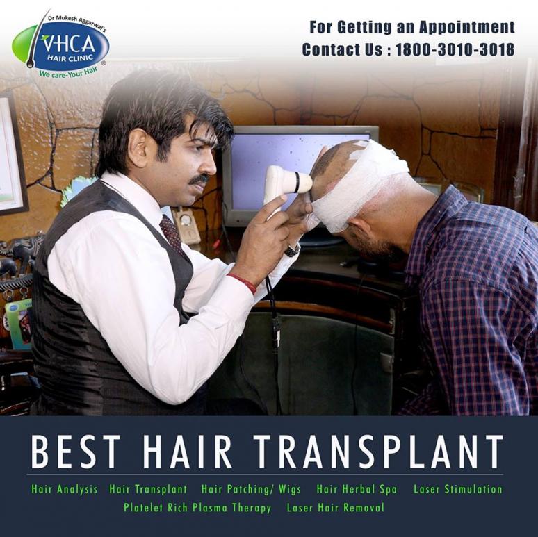 best hair transplant in delhi