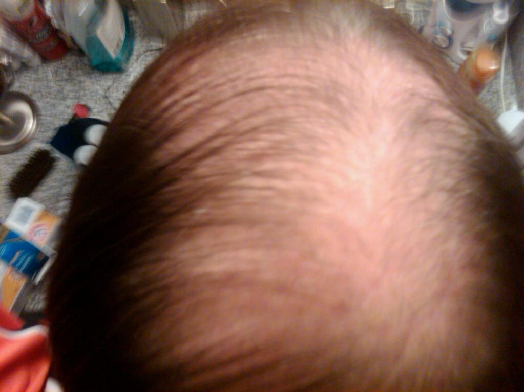 Click image for larger version

Name:	my_bald_head_7_4_2010.jpg

Size:	62.9 KB
ID:	6525