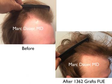 Click image for larger version

Name:	Hair Transplant Slides copy10.001.jpg

Size:	12.9 KB
ID:	45514