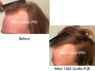Click image for larger version

Name:	Hair Transplant Slides copy10.002.jpg

Size:	12.6 KB
ID:	45515