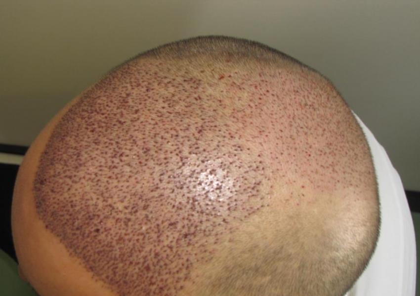Click image for larger version

Name:	16-4th day, 850 grafts from beard area for vertex.jpg

Size:	79.9 KB
ID:	21909