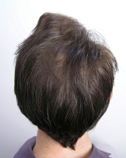 After hair transplantation and Propecia