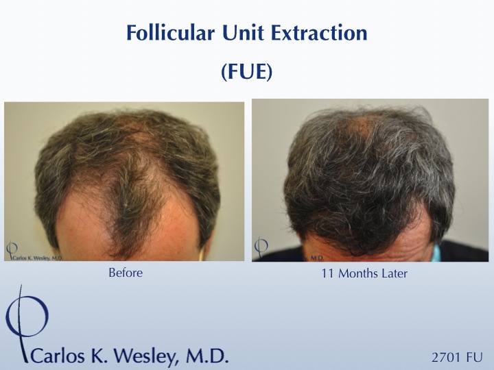Follicular Unit Extraction (FUE) with Dr. Carlos K. Wesley in New York City.  Before/After 2701 FUE grafts using a combination of 0.8mm and 0.9mm...