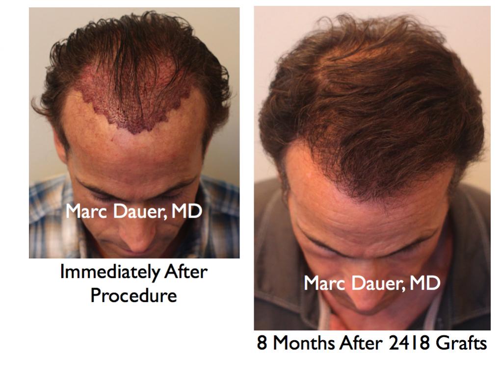 Click image for larger version

Name:	Hair Transplant Slides3.168.jpg

Size:	78.5 KB
ID:	33040