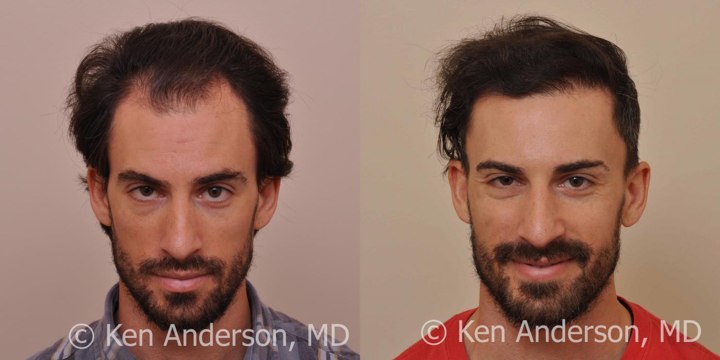 Jason Nicola	 
Norwood 3 
Age: 34 
Surgeon: Dr. Ken Anderson, MD 
Location: Atlanta, Georgia 
	 
Clinical History: 
Jasons initial consultation with...