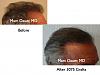 Click image for larger version

Name:	Hair Transplant Slides6.042.jpg

Size:	68.8 KB
ID:	23663