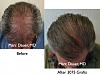 Click image for larger version

Name:	Hair Transplant Slides6.043.jpg

Size:	92.2 KB
ID:	23664