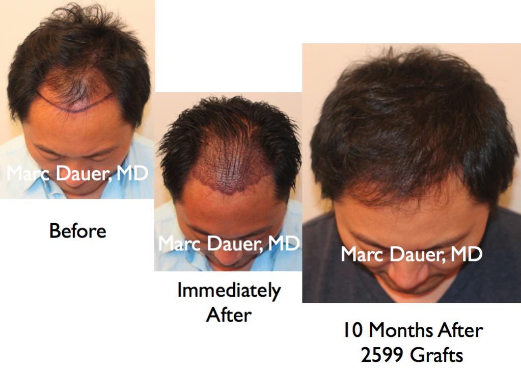 Click image for larger version

Name:	Hair Transplant Slides1.220.jpg

Size:	71.2 KB
ID:	34080