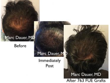 Click image for larger version

Name:	Hair Transplant Slides copy30.001.jpg

Size:	15.6 KB
ID:	45132