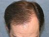 Click image for larger version

Name:	09_after-1st-hair-transplant-one-year-top-view.jpg

Size:	57.3 KB
ID:	7203